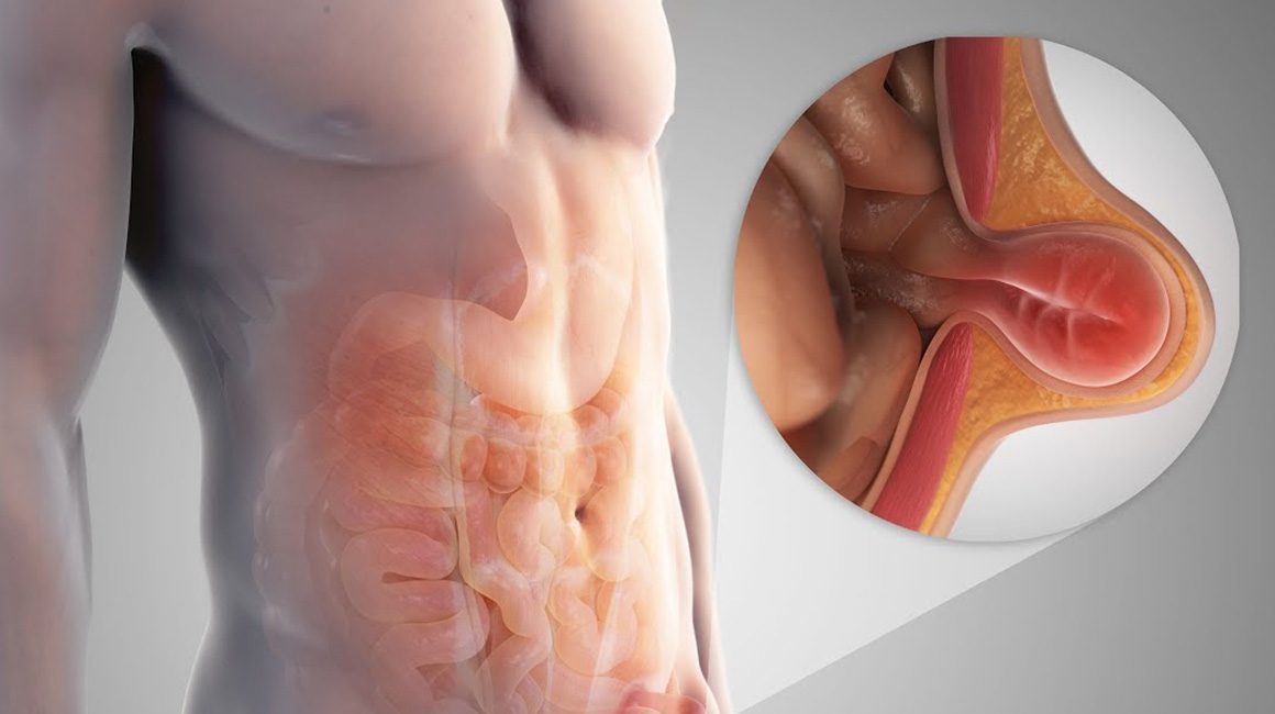 Fıtık Nedir?