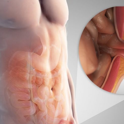 Fıtık Nedir?